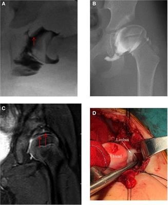 Management and effects of residual limbus inversion following closed reduction in developmental hip dysplasia: Protocol for a multicenter randomized controlled trial